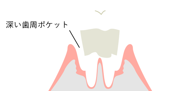 深い歯周ポケット